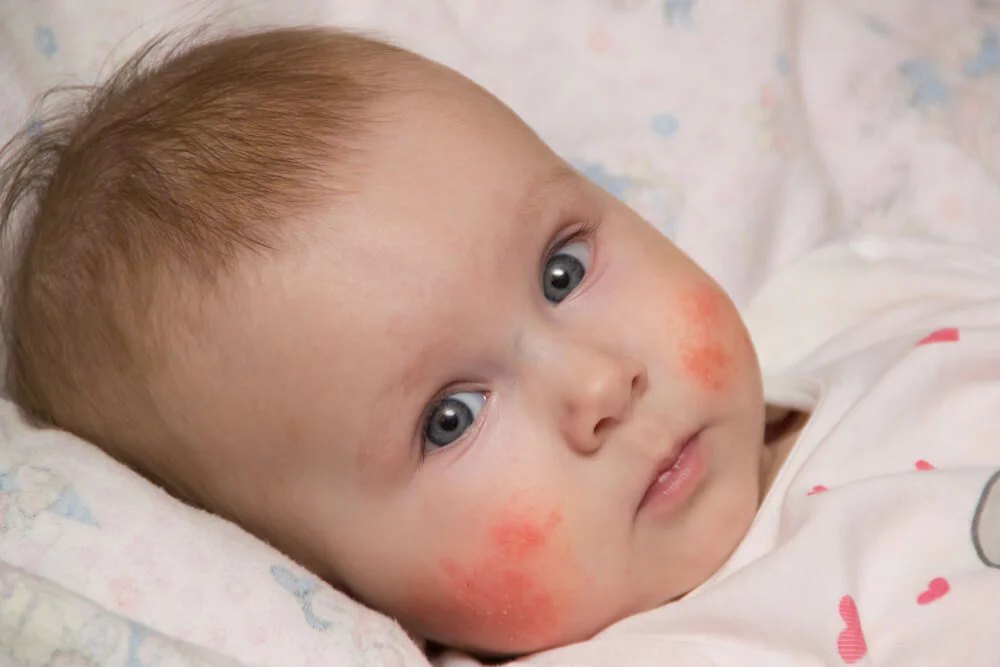 Las mejillas de mi bebé están rojas ¿Qué es la dermatitis atópica?