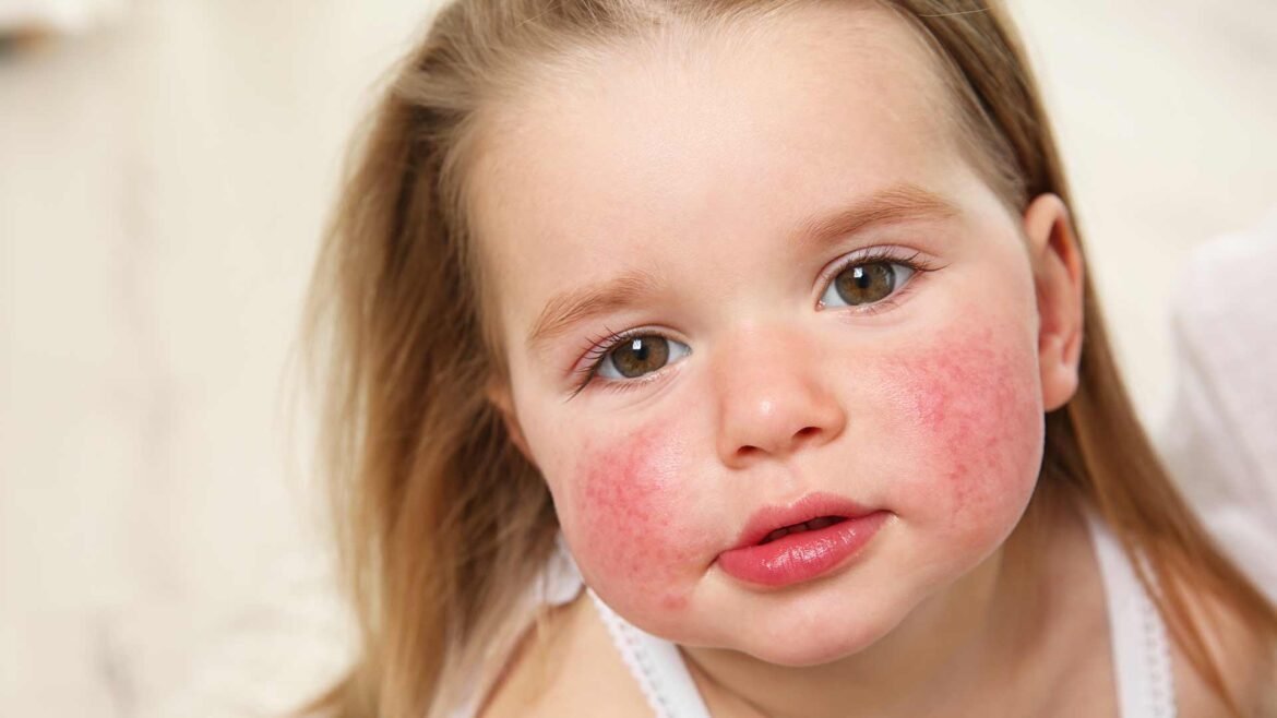 dermatitis atopica en bebes