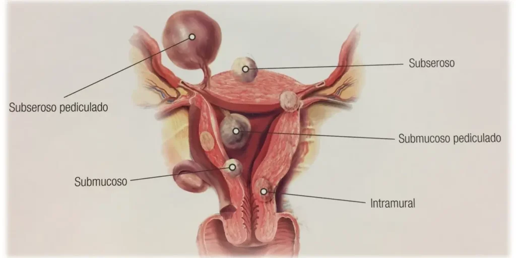 En general, es importante que las mujeres que tienen miomas y quedan embarazadas se comuniquen con su equipo médico para recibir un seguimiento adecuado durante el embarazo, el parto y el período postparto. Esto les permitirá monitorear cualquier cambio en los miomas y tomar decisiones informadas sobre el manejo de esta condición para garantizar la salud y el bienestar tanto de la madre como del bebé.